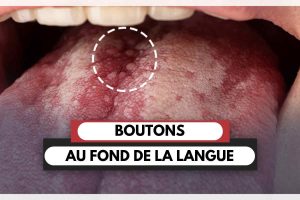 bouton au fond de la langue