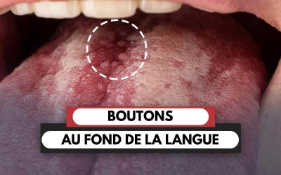 Boutons au fond de la langue : causes, symptômes et solutions