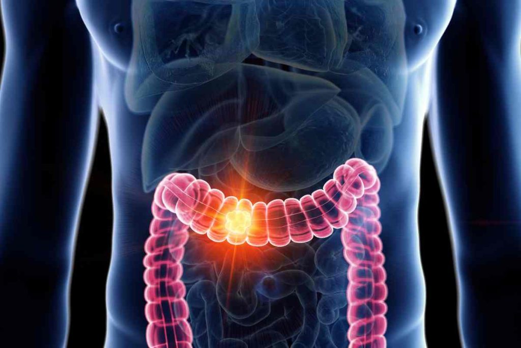 comment meurt-on d'un cancer du colon